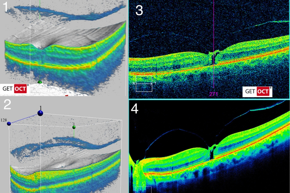 Zeiss Cirrus Optical Coherence Tomography (OCT)